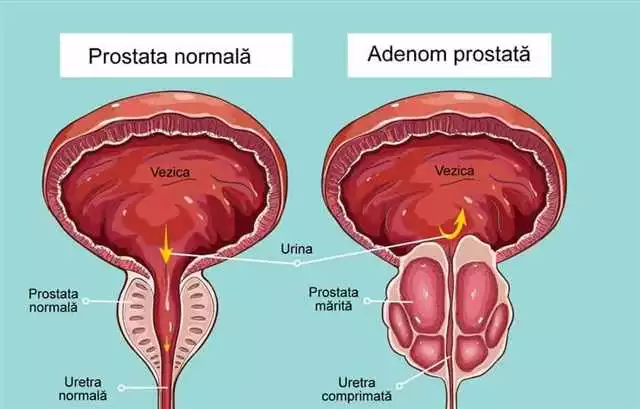 Cum să utilizați Vitaprost – Ghid detaliat pentru tratamentul afecțiunilor prostatei