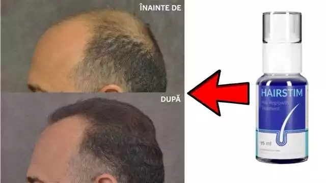 Prețul Hairstim în Bacău: Tratament eficient pentru căderea părului – HairStim.ro